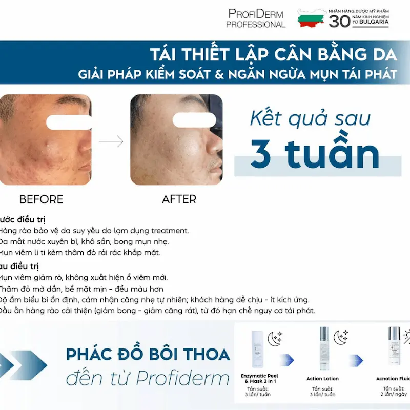 Gợi ý sản phẩm trị mụn hiệu quả từ Profiderm Gợi ý sản phẩm trị mụn hiệu quả từ Profiderm