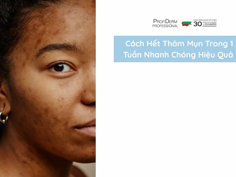 hết thâm mụn trong 1 tuần