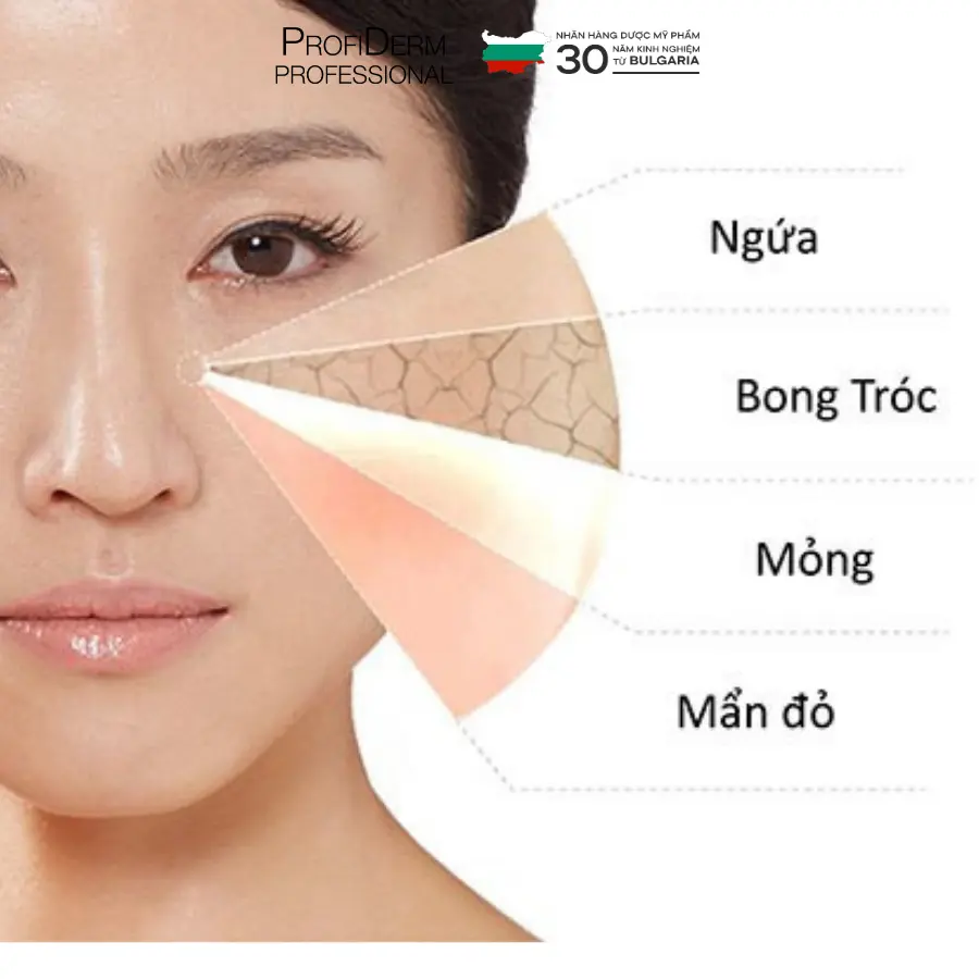 phục hồi da mụn phục hồi da mụn