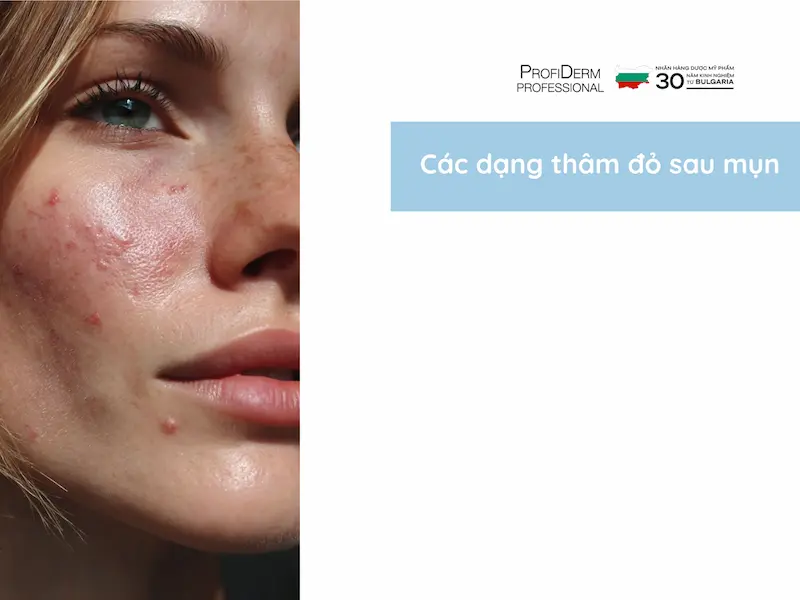 thâm đỏ sau mụn thâm đỏ sau mụn
