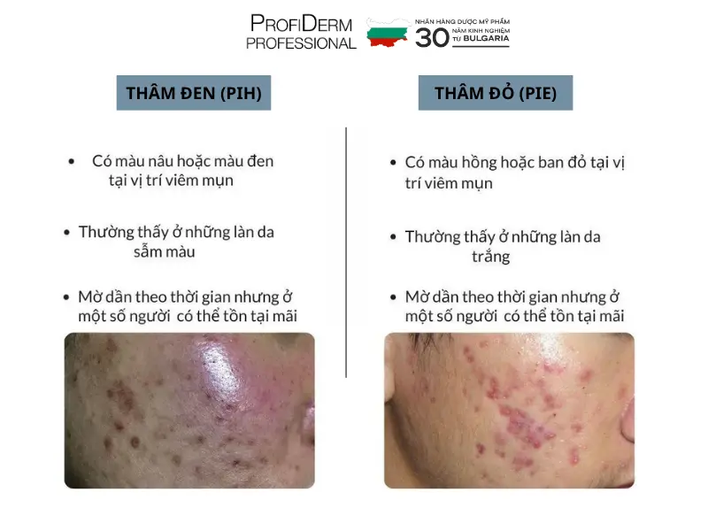 phục hồi da thâm mụn phục hồi da thâm mụn