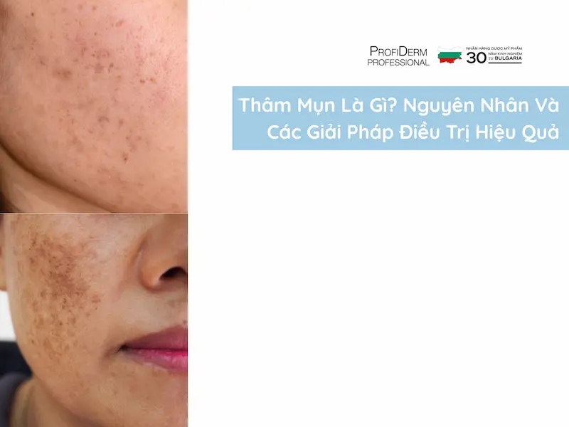 thâm mụn thâm mụn