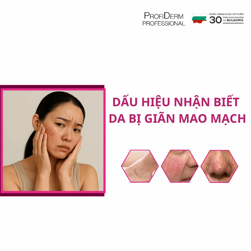 giãn mao mạch có tự khỏi không giãn mao mạch có tự khỏi không