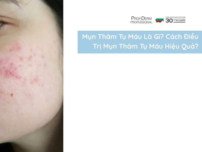 mụn thâm tụ máu mụn thâm tụ máu