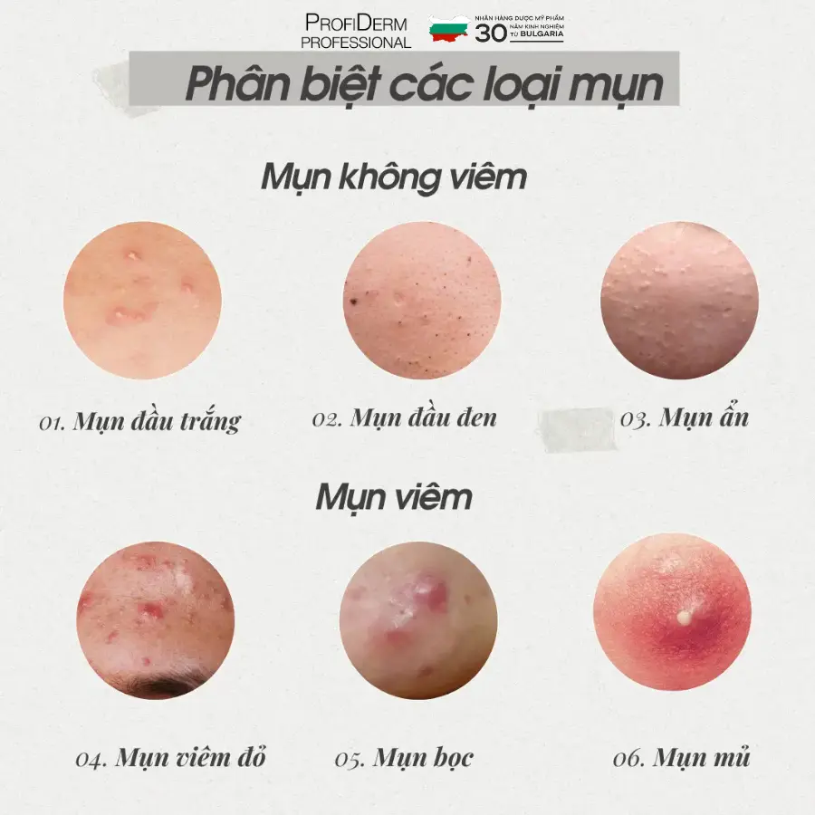 các loại thâm mụn các loại thâm mụn