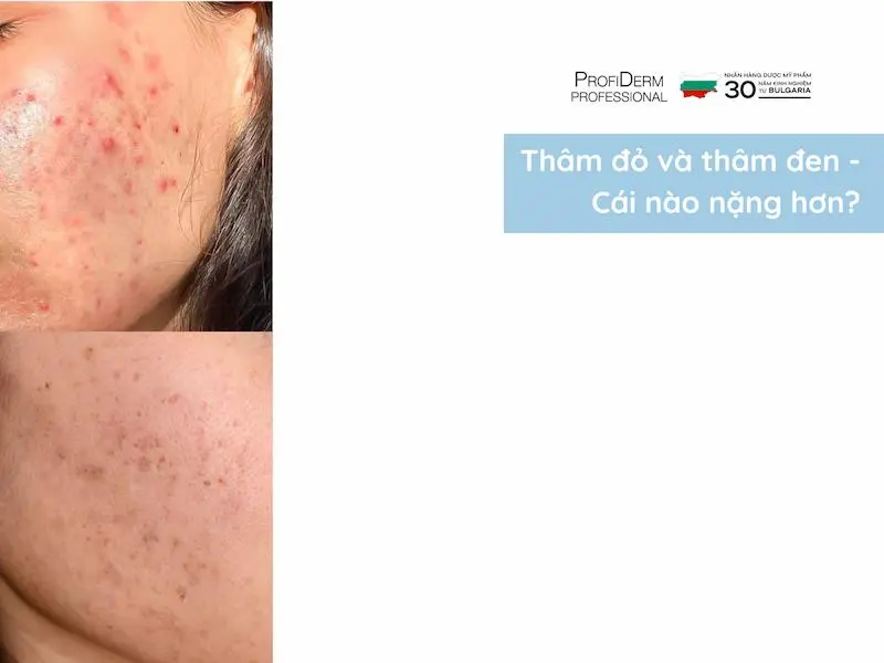 thâm đỏ và thâm đen cái nào nặng hơn thâm đỏ và thâm đen cái nào nặng hơn
