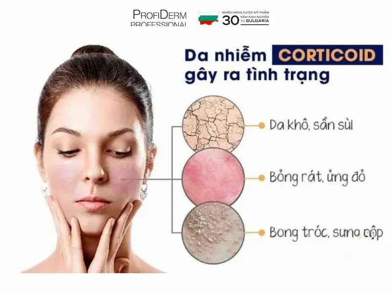 phục hồi da nhiễm corticoid phục hồi da nhiễm corticoid