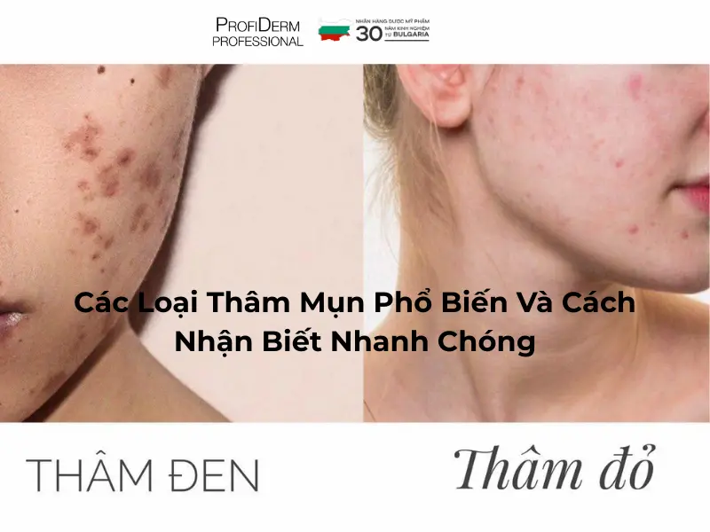 các loại thâm mụn các loại thâm mụn