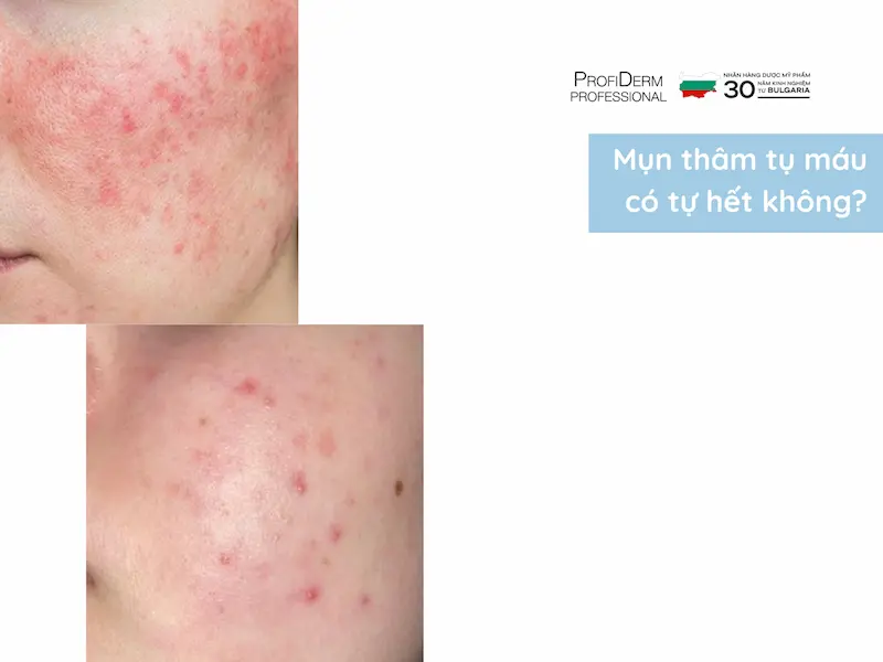 mụn thâm tụ máu có tự hết không mụn thâm tụ máu có tự hết không