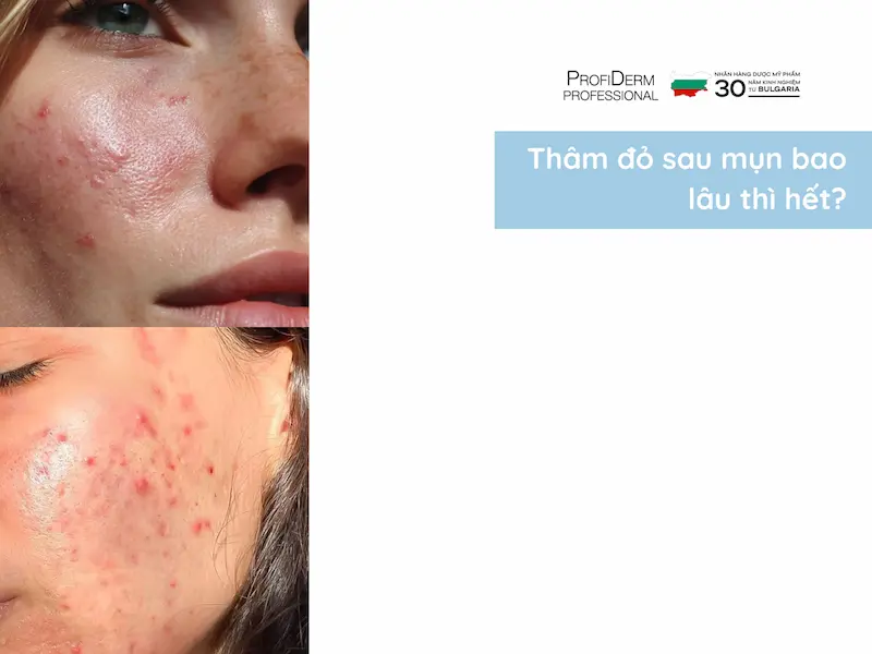 thâm đỏ sau mụn bao lâu thì hết thâm đỏ sau mụn bao lâu thì hết