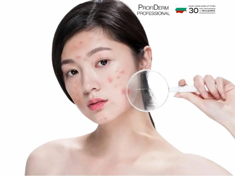 các hoạt chất trị thâm đỏ các hoạt chất trị thâm đỏ