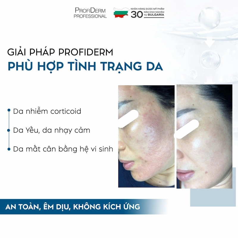 Profiderm Việt Nam – Địa chỉ phân phối Azexo Pure Gel uy tín Profiderm Việt Nam – Địa chỉ phân phối Azexo Pure Gel uy tín
