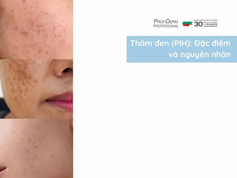 thâm đỏ và thâm đen cái nào nặng hơn thâm đỏ và thâm đen cái nào nặng hơn