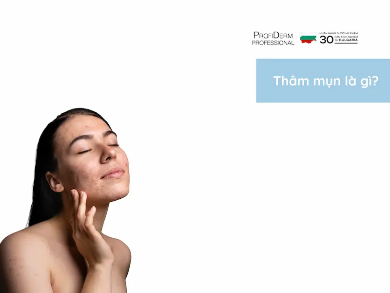 thâm đỏ sau mụn bao lâu thì hết thâm đỏ sau mụn bao lâu thì hết