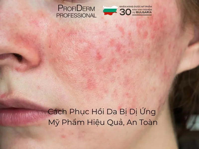cách phục hồi da bị dị ứng mỹ phẩm cách phục hồi da bị dị ứng mỹ phẩm