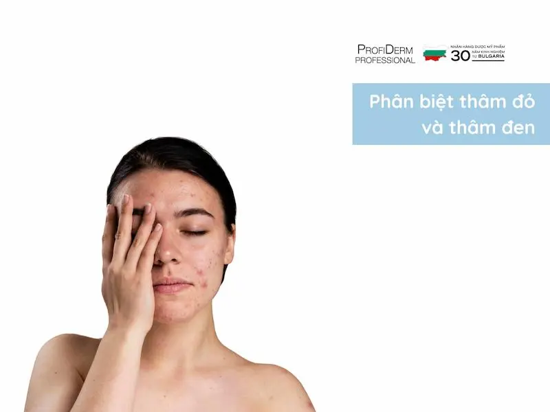 Phân biệt thâm đỏ và thâm đen: bảng so sánh nhanh Phân biệt thâm đỏ và thâm đen: bảng so sánh nhanh