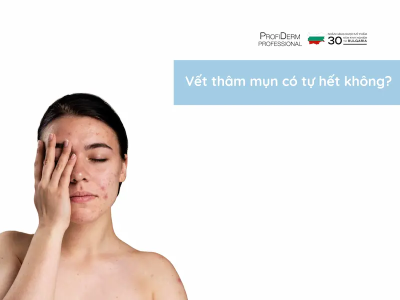 Vết thâm mụn có tự hết không? Vết thâm mụn có tự hết không?