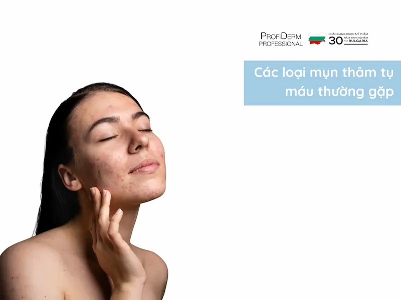 mụn thâm tụ máu mụn thâm tụ máu