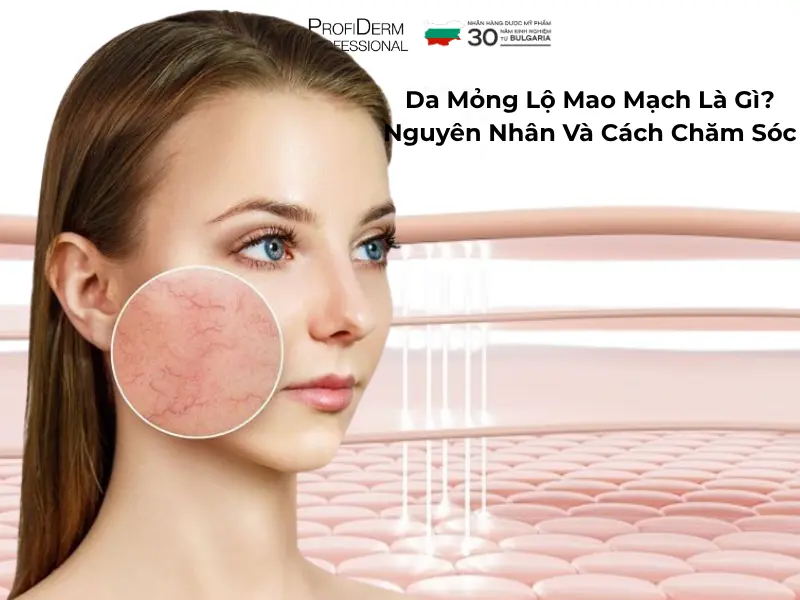 da mỏng lộ mao mạch da mỏng lộ mao mạch