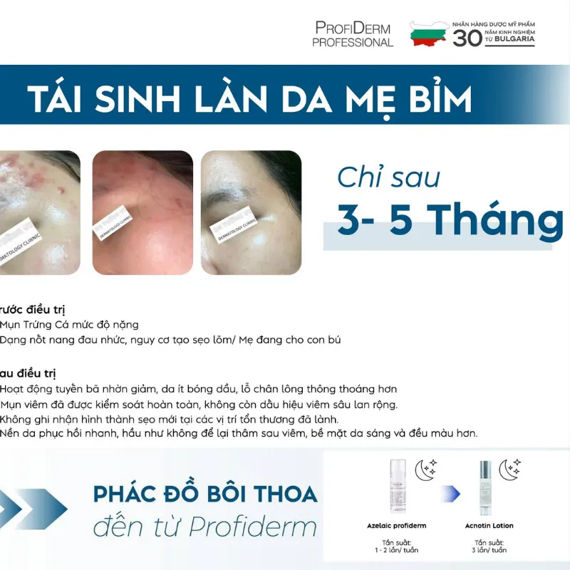 Tại sao nên chọn sản phẩm tẩy tế bào chết hóa học từ Profiderm Việt Nam? Tại sao nên chọn sản phẩm tẩy tế bào chết hóa học từ Profiderm Việt Nam?