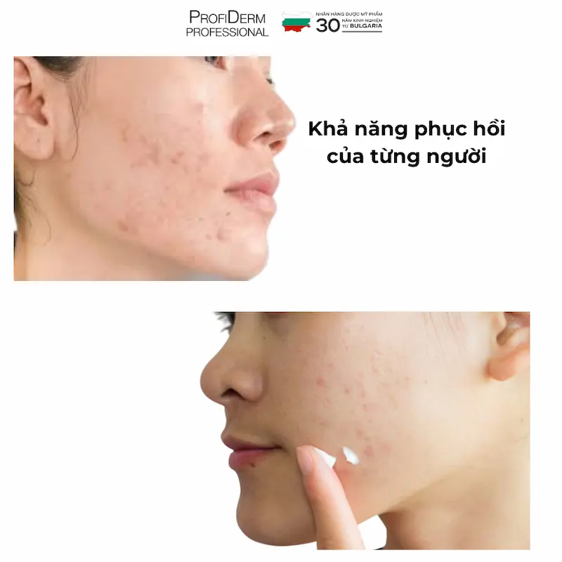 vết thâm mụn có tự hết không vết thâm mụn có tự hết không