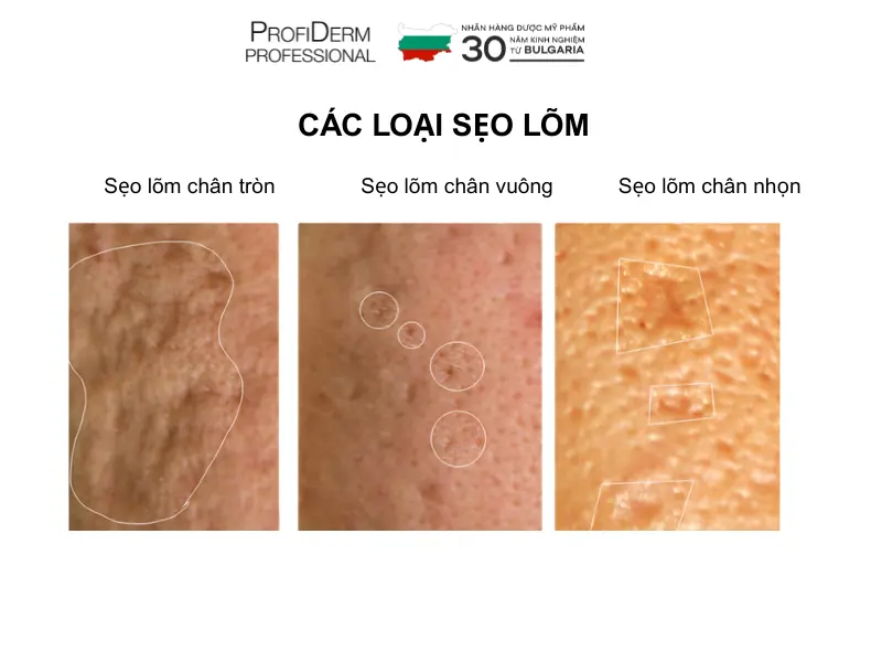 phục hồi da sau nặn mụn phục hồi da sau nặn mụn