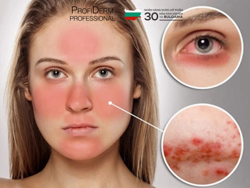 dấu hiệu nhận biết da nhạy cảm dấu hiệu nhận biết da nhạy cảm