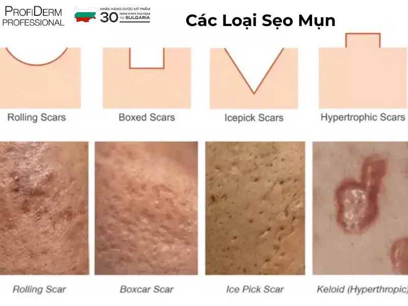 các loại thâm mụn các loại thâm mụn