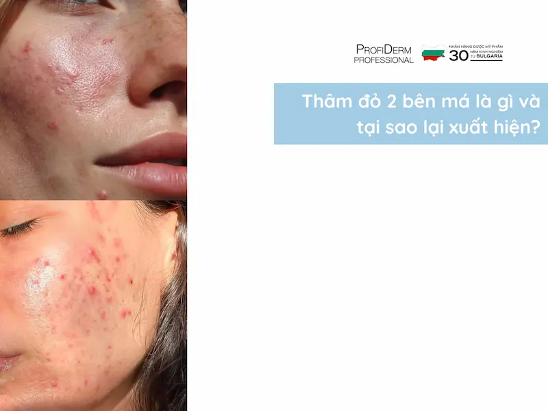 cách trị thâm đỏ 2 bên má cách trị thâm đỏ 2 bên má
