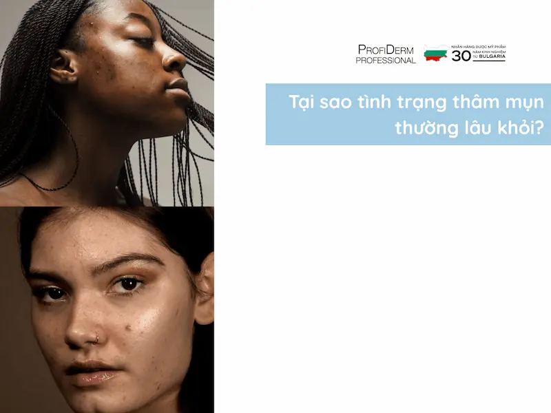 hết thâm mụn trong 1 tuần hết thâm mụn trong 1 tuần