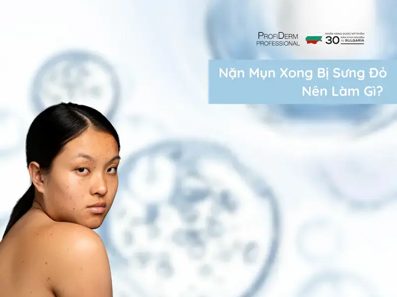 Nặn Mụn Xong Bị Sưng Đỏ Nên Làm Gì? Kinh Nghiệm Chuyên Gia