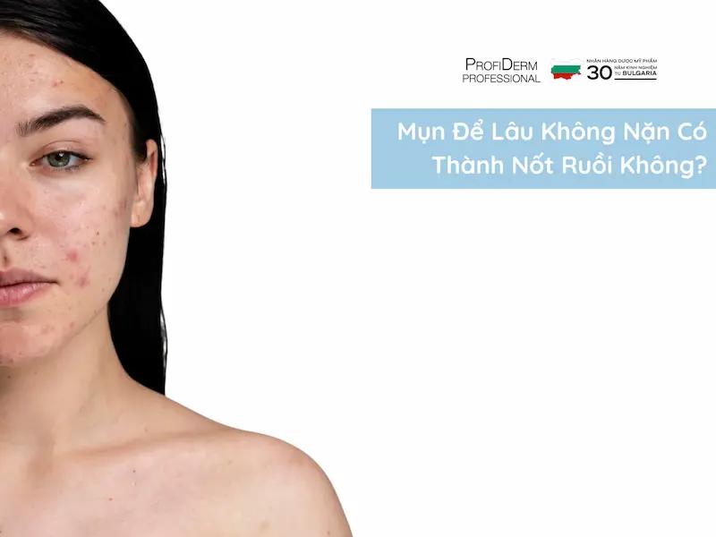 #Mụn Để Lâu Không Nặn Có Thành Nốt Ruồi Không?