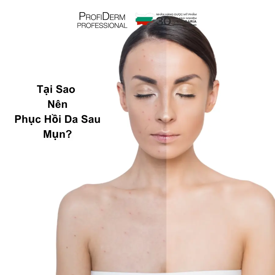 phục hồi da mụn phục hồi da mụn