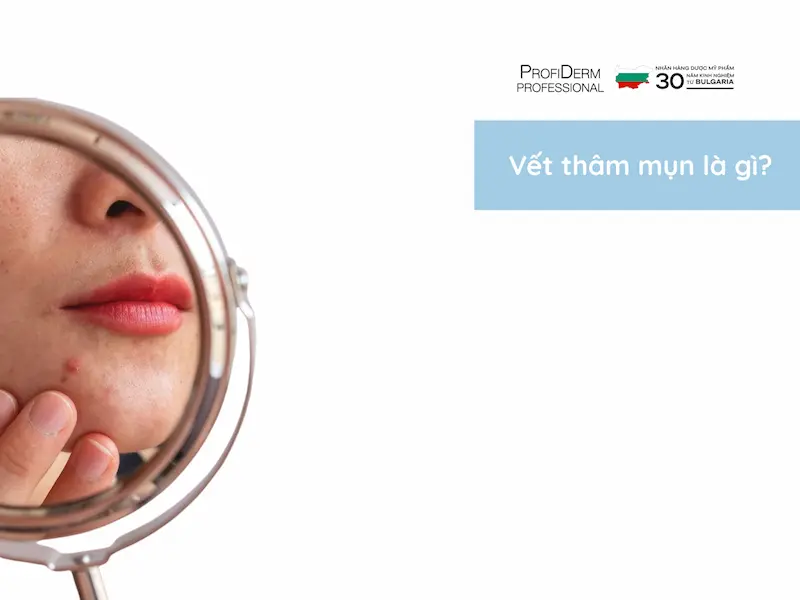 vết thâm mụn mãi không hết vết thâm mụn mãi không hết