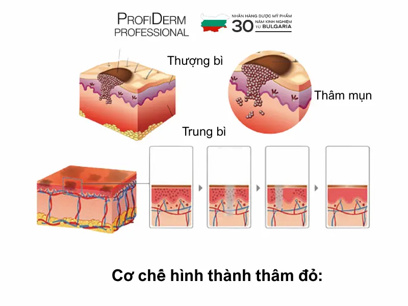 trị thâm đỏ sau mụn nhanh nhất tại nhà trị thâm đỏ sau mụn nhanh nhất tại nhà