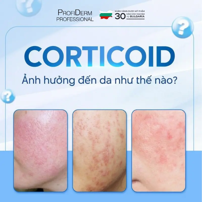 da mỏng lộ mao mạch da mỏng lộ mao mạch