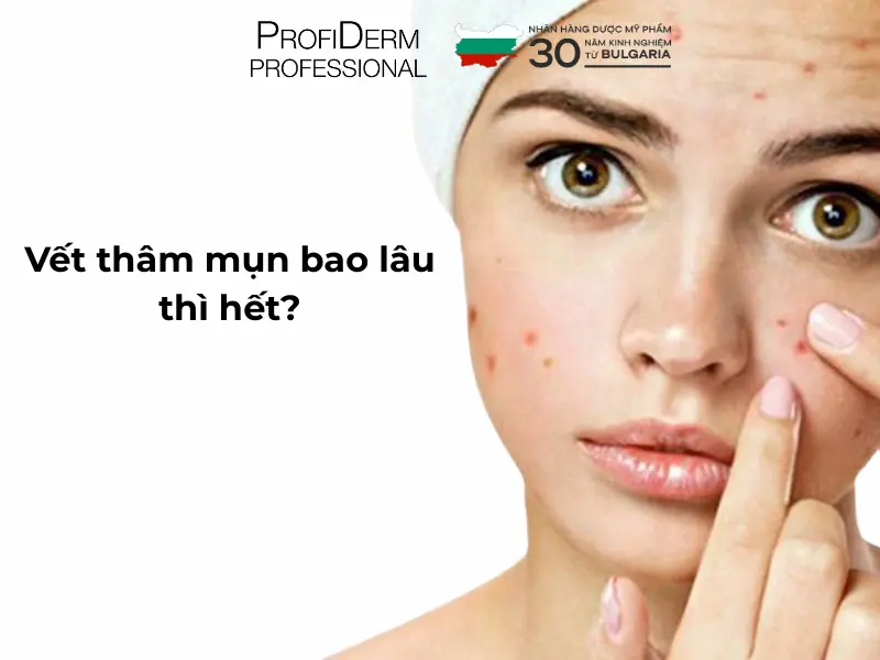 Vết thâm mụn bao lâu thì hết? Vết thâm mụn bao lâu thì hết?