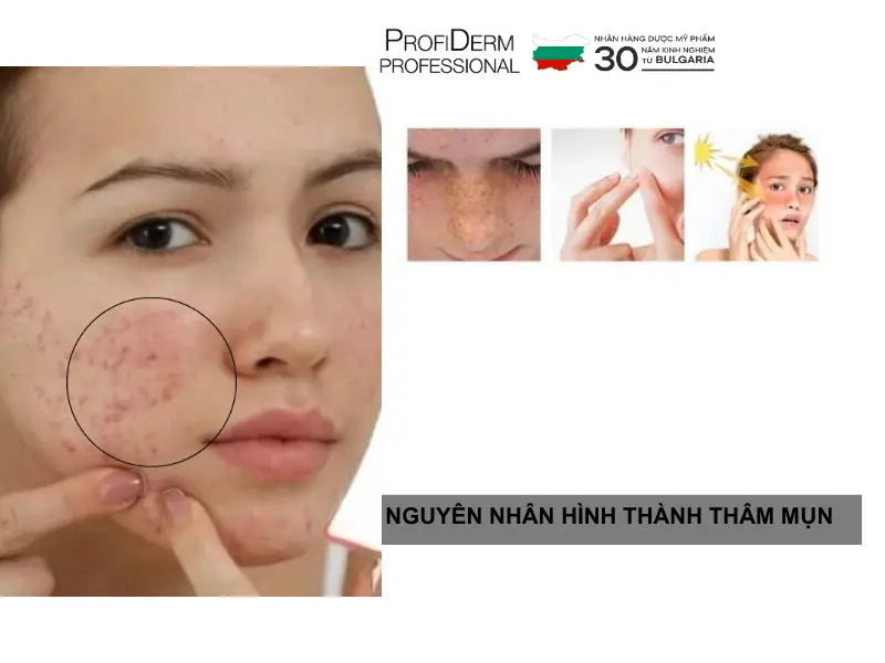 phục hồi da thâm mụn phục hồi da thâm mụn