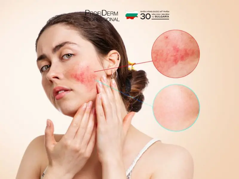hồng ban sau viêm hồng ban sau viêm