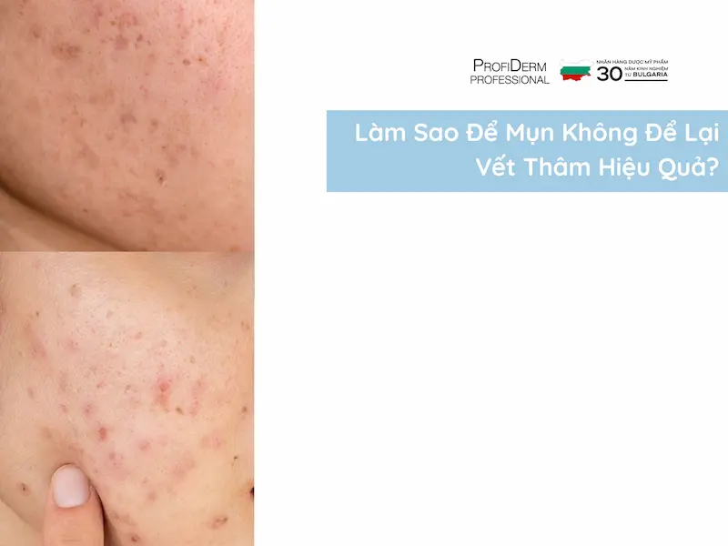 làm sao để mụn không để lại vết thâm làm sao để mụn không để lại vết thâm