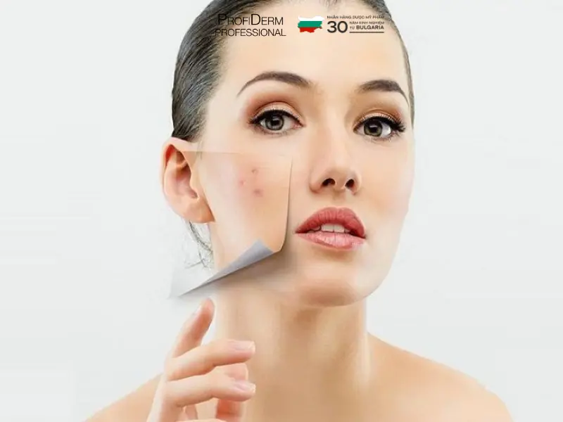 các hoạt chất trị thâm đỏ các hoạt chất trị thâm đỏ