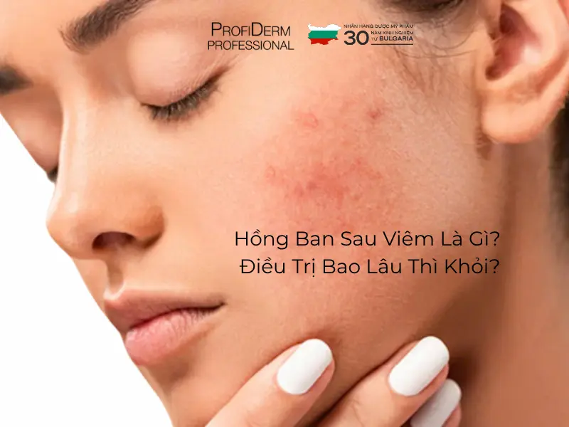 hồng ban sau viêm hồng ban sau viêm