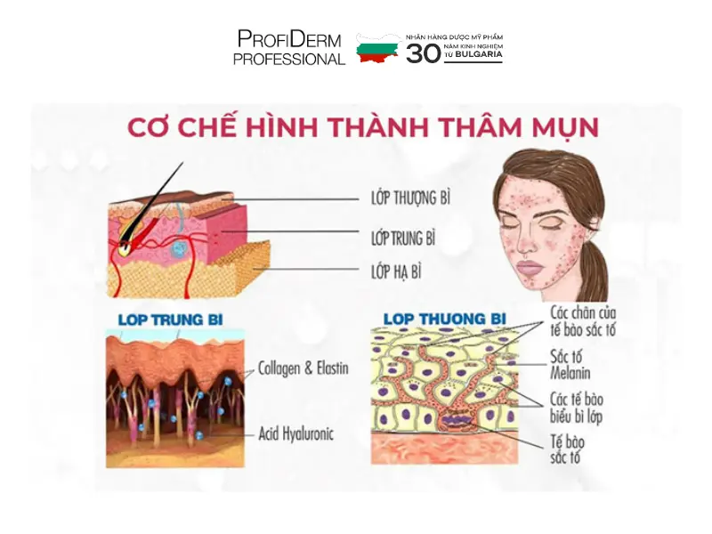 phục hồi da thâm mụn phục hồi da thâm mụn