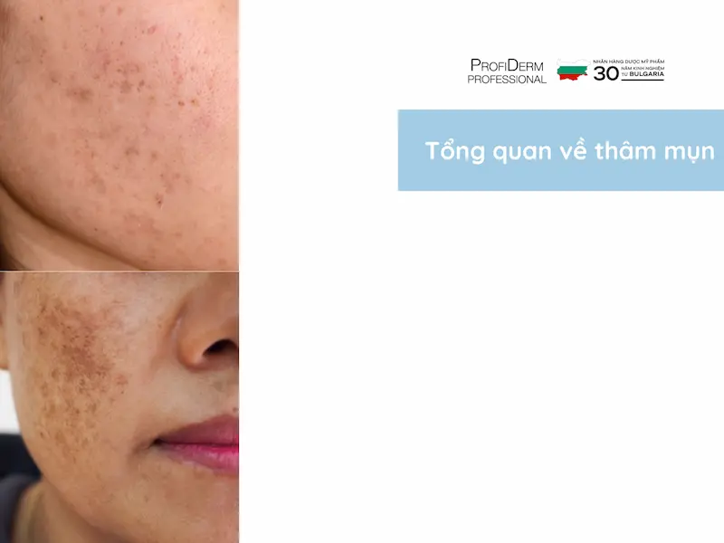 kem chống nắng trị thâm kem chống nắng trị thâm