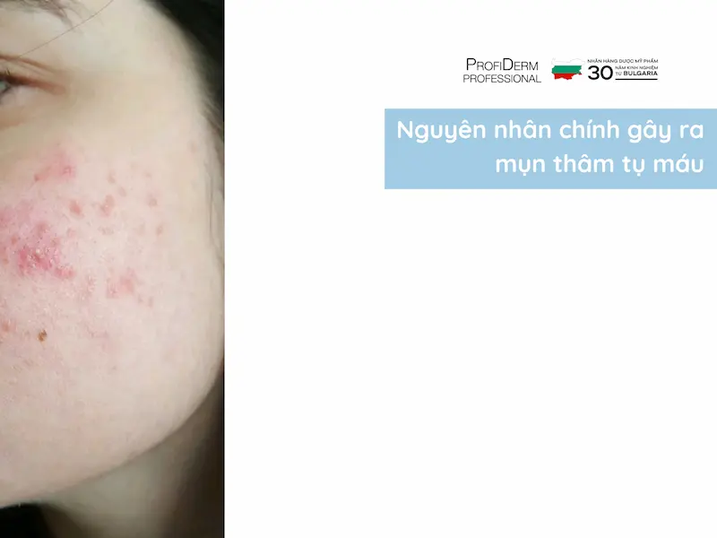 mụn thâm tụ máu có tự hết không mụn thâm tụ máu có tự hết không