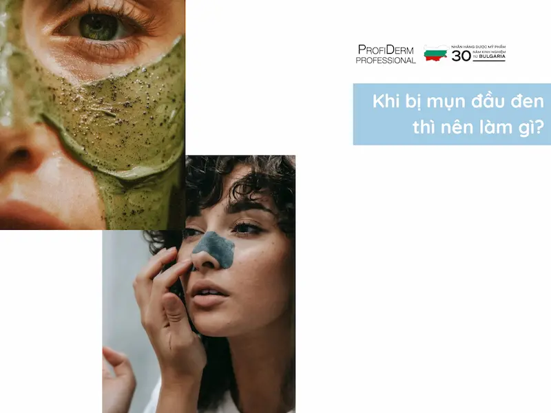 Khi bị mụn đầu đen thì nên làm gì? Khi bị mụn đầu đen thì nên làm gì?
