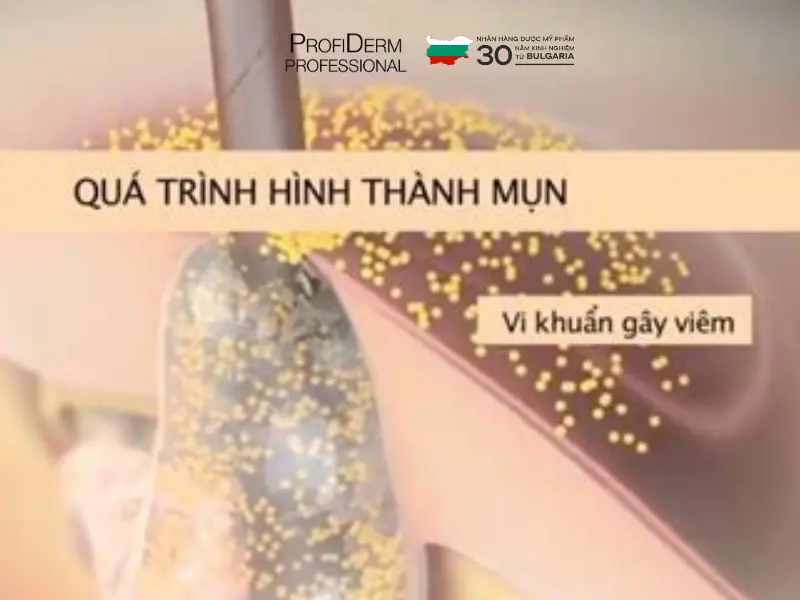 các loại thâm mụn các loại thâm mụn