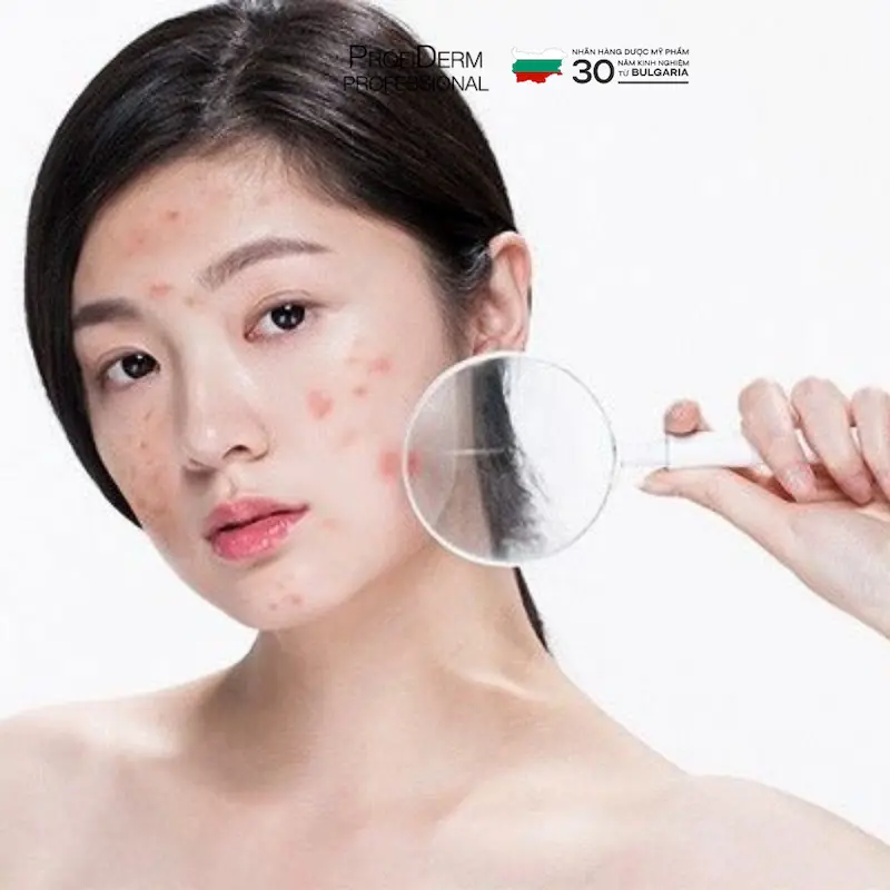 skincare mà vẫn bị mụn skincare mà vẫn bị mụn