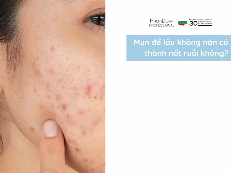 mụn để lâu không nặn có thành nốt ruồi không mụn để lâu không nặn có thành nốt ruồi không