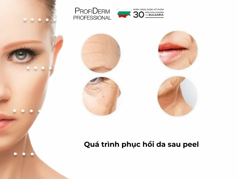 phục hồi da sau peel phục hồi da sau peel